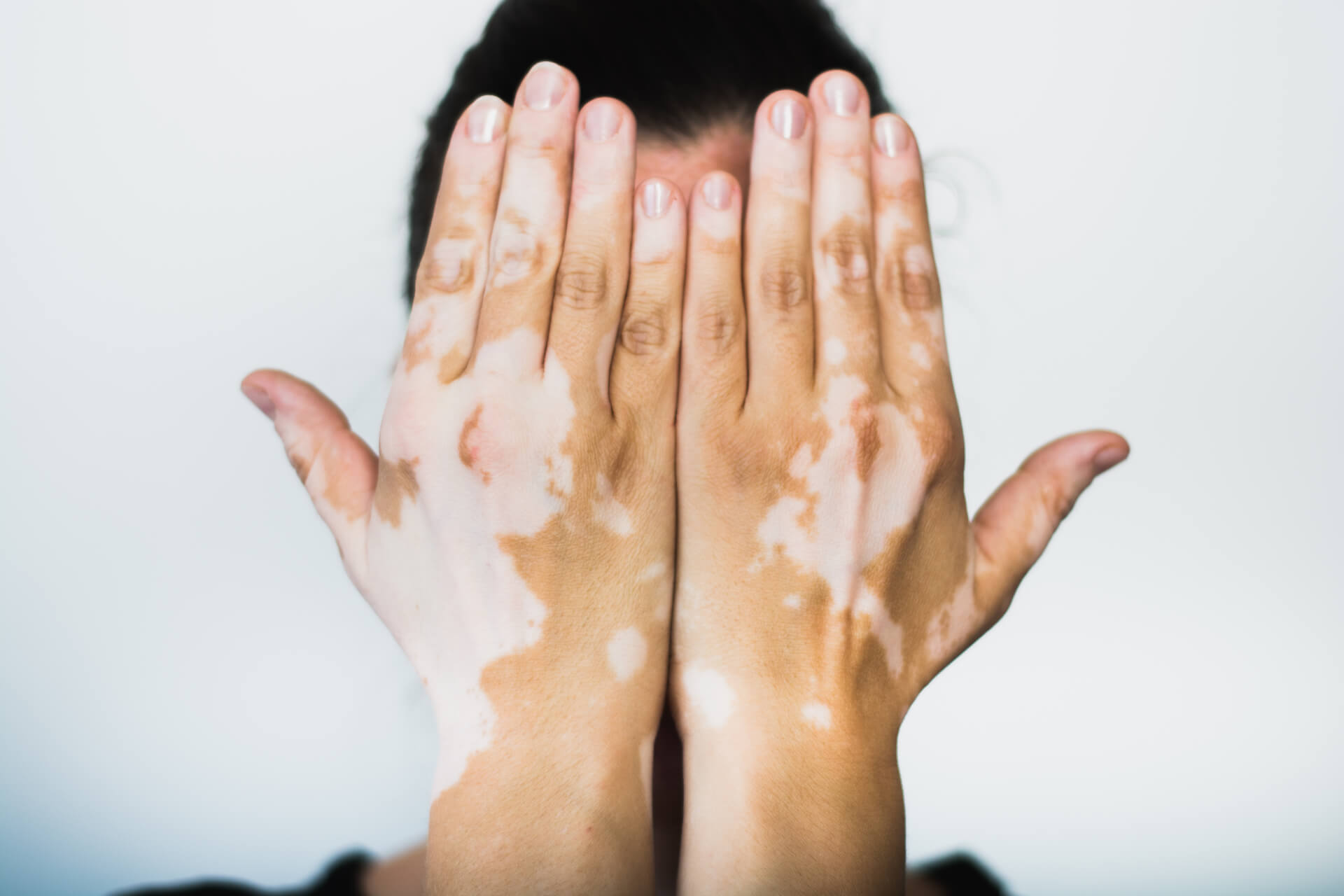 Vitiligo