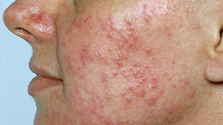 Rosacea (Gül Hastalığı)