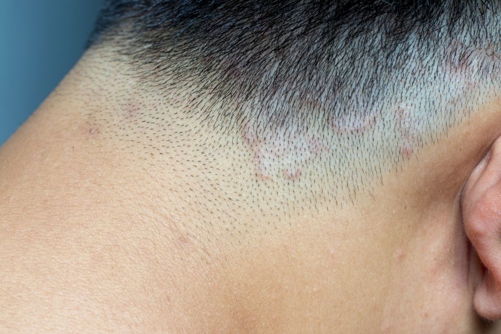 Alopesi Areata (Saçkıran)